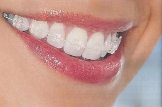 brackets-esteticos