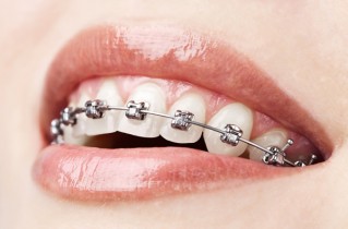 brackets-metalicos